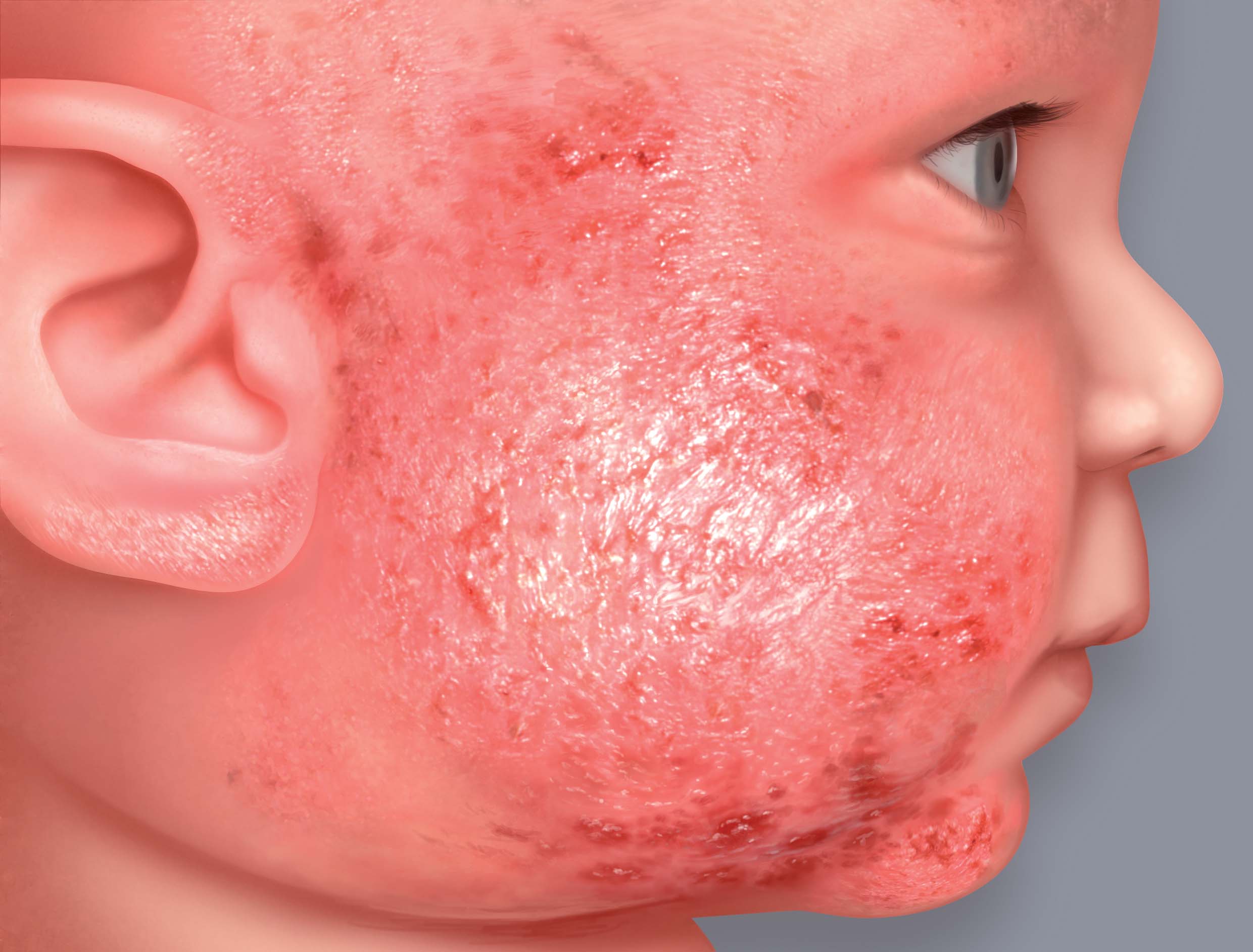 eczema face baby