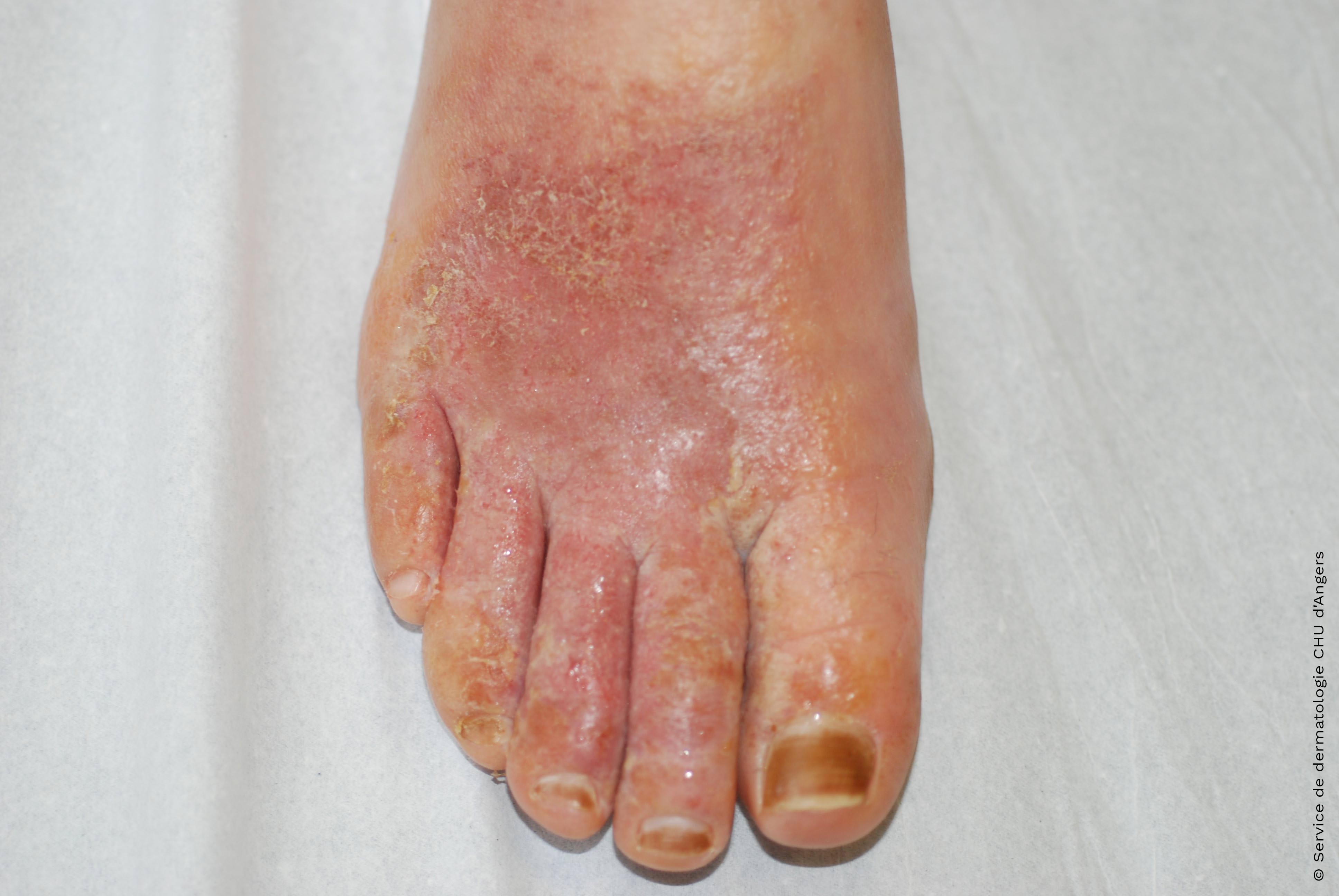 Eczema de contato agudo do pé ao óleo de Malaleuca (tea tree)