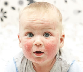Eczema atópico do rosto