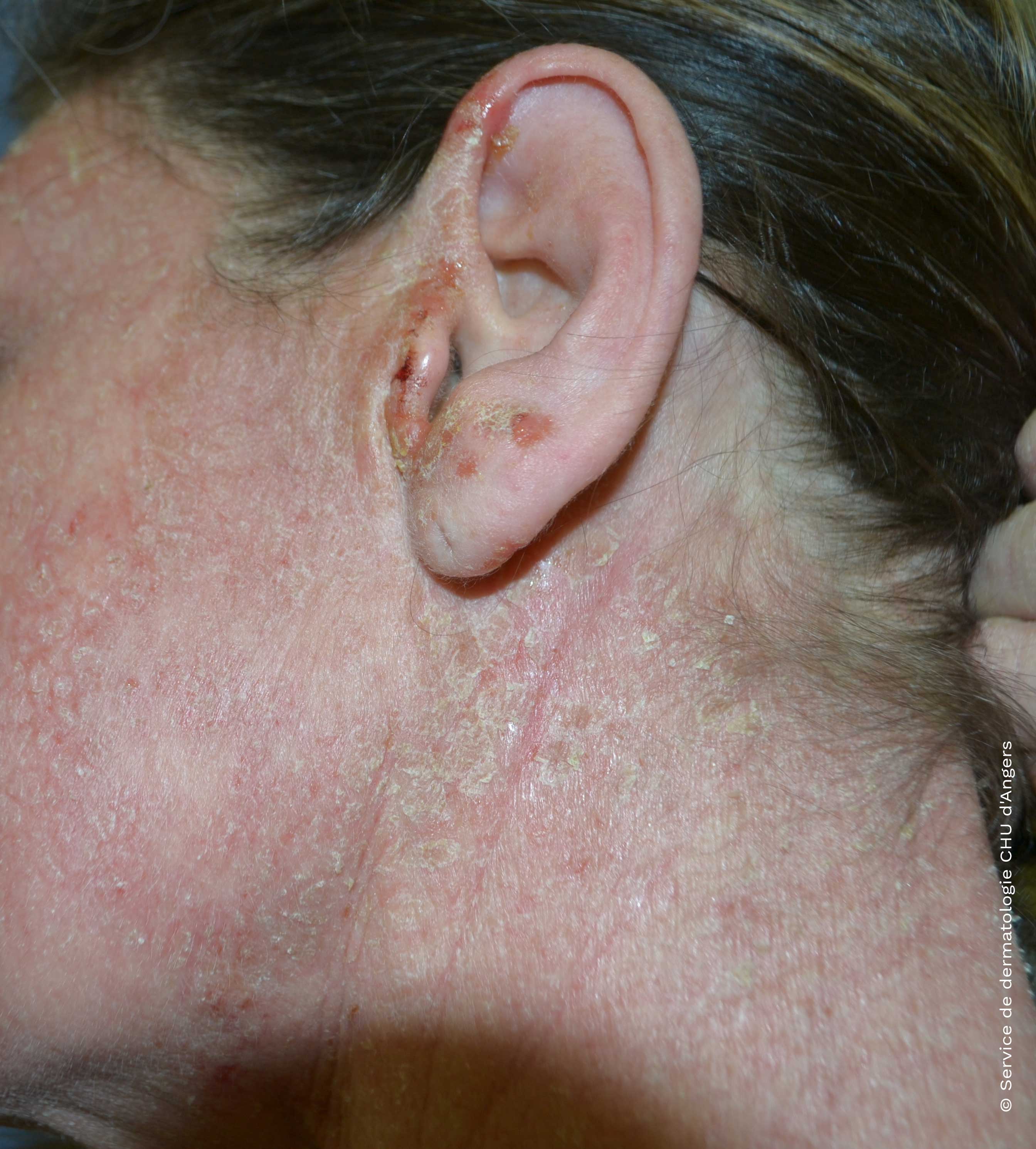 Eczema atópico do rosto e do pescoço