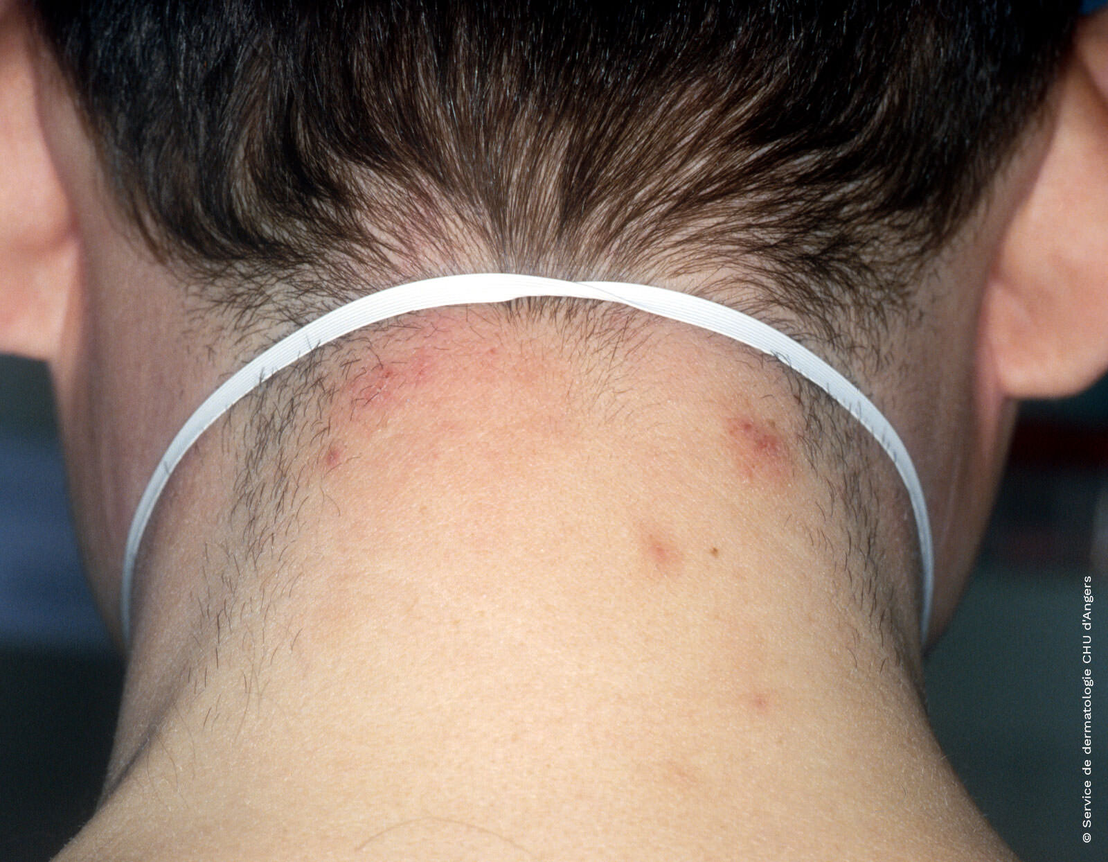 eczema on back of neck