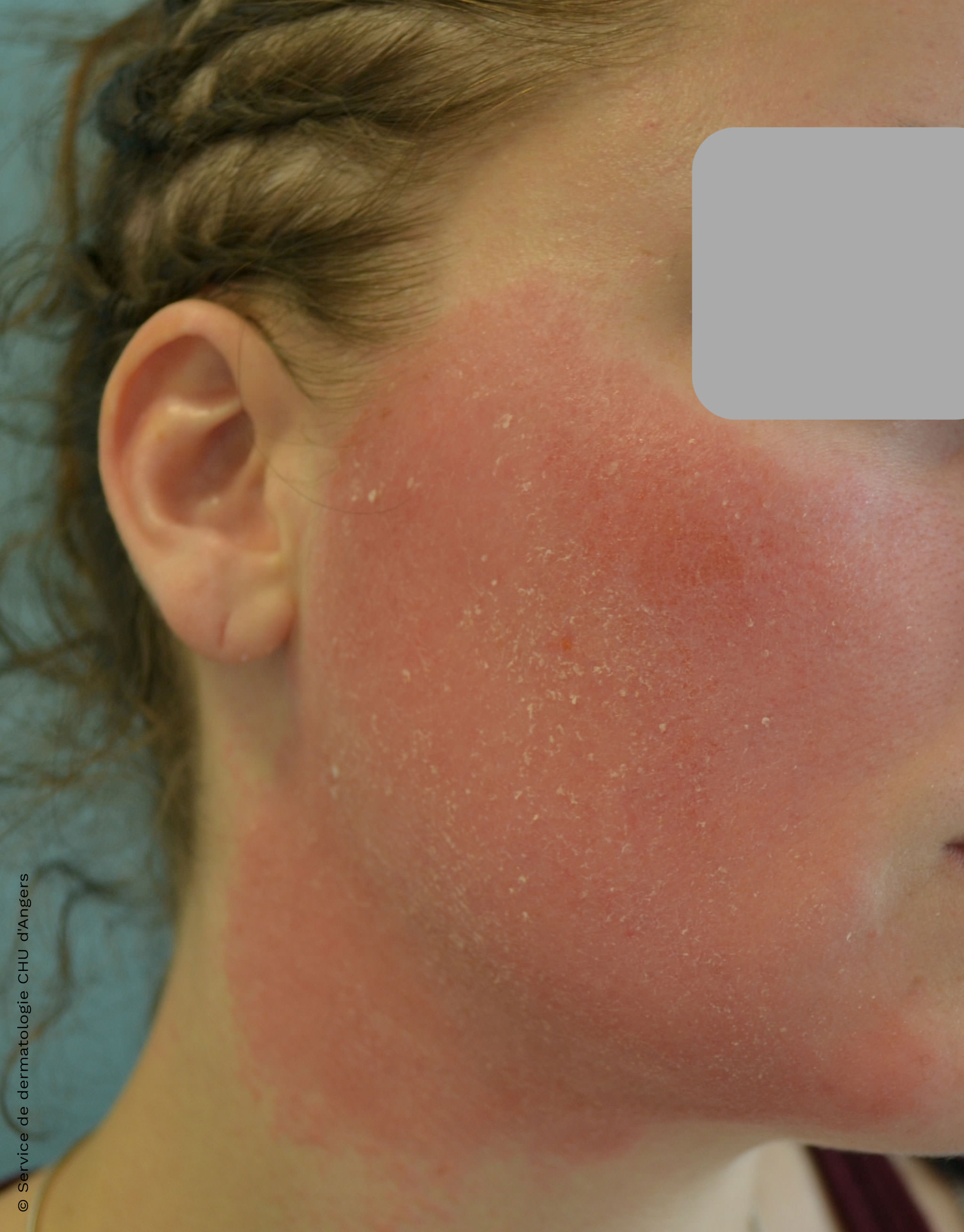 Eczema de contato do rosto a um antifúngico