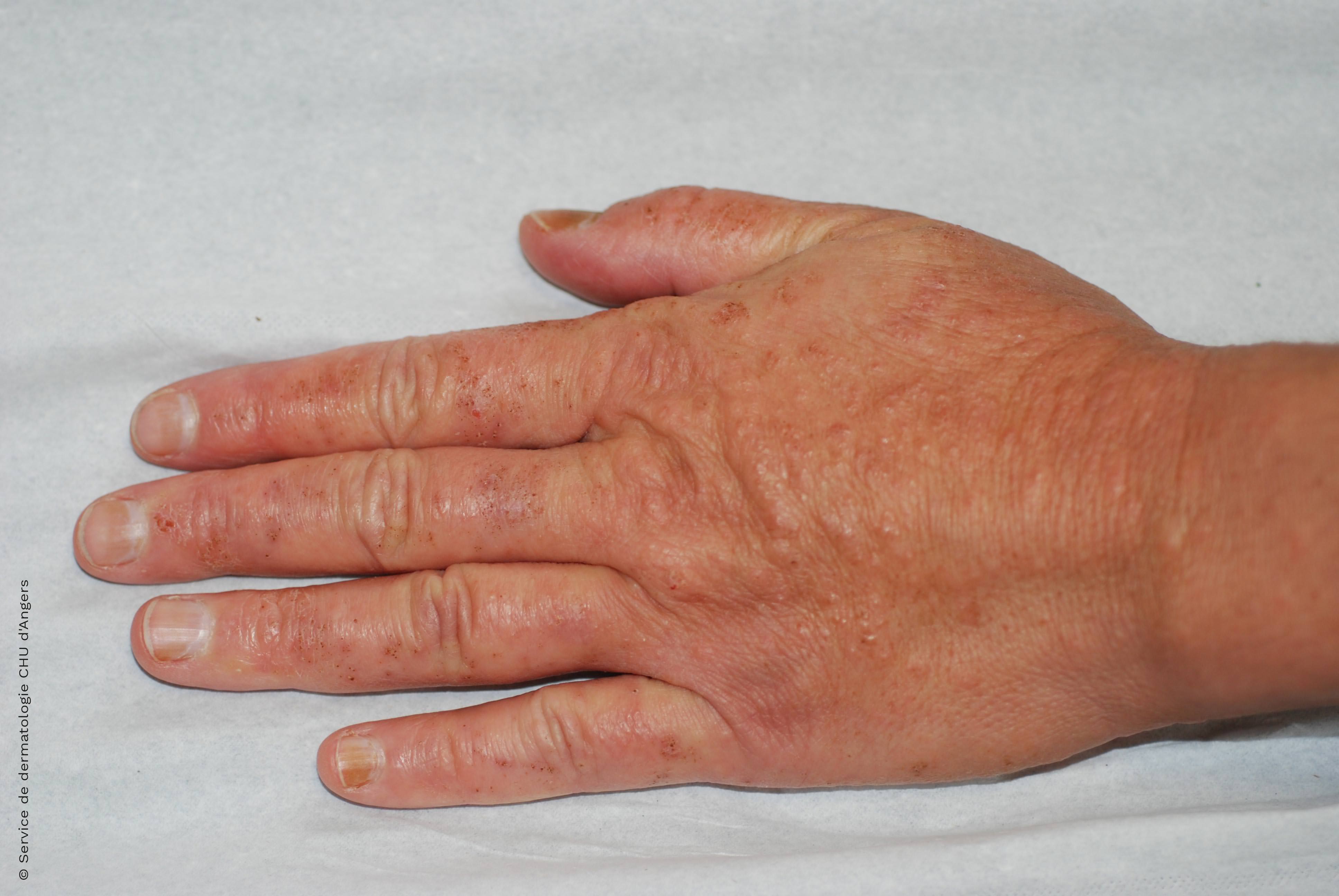 Eczema de contato das mãos