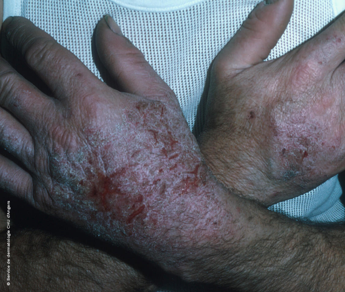 Eczema de contacto subagudo en las manos