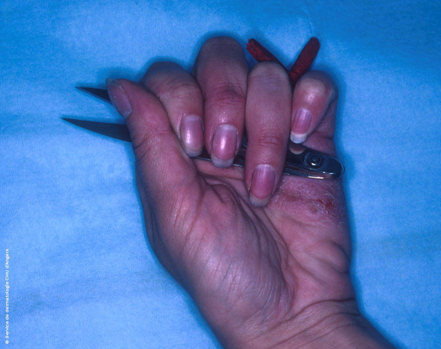Eczema da contatto delle mani, nichel contenuto nella forbice professionale