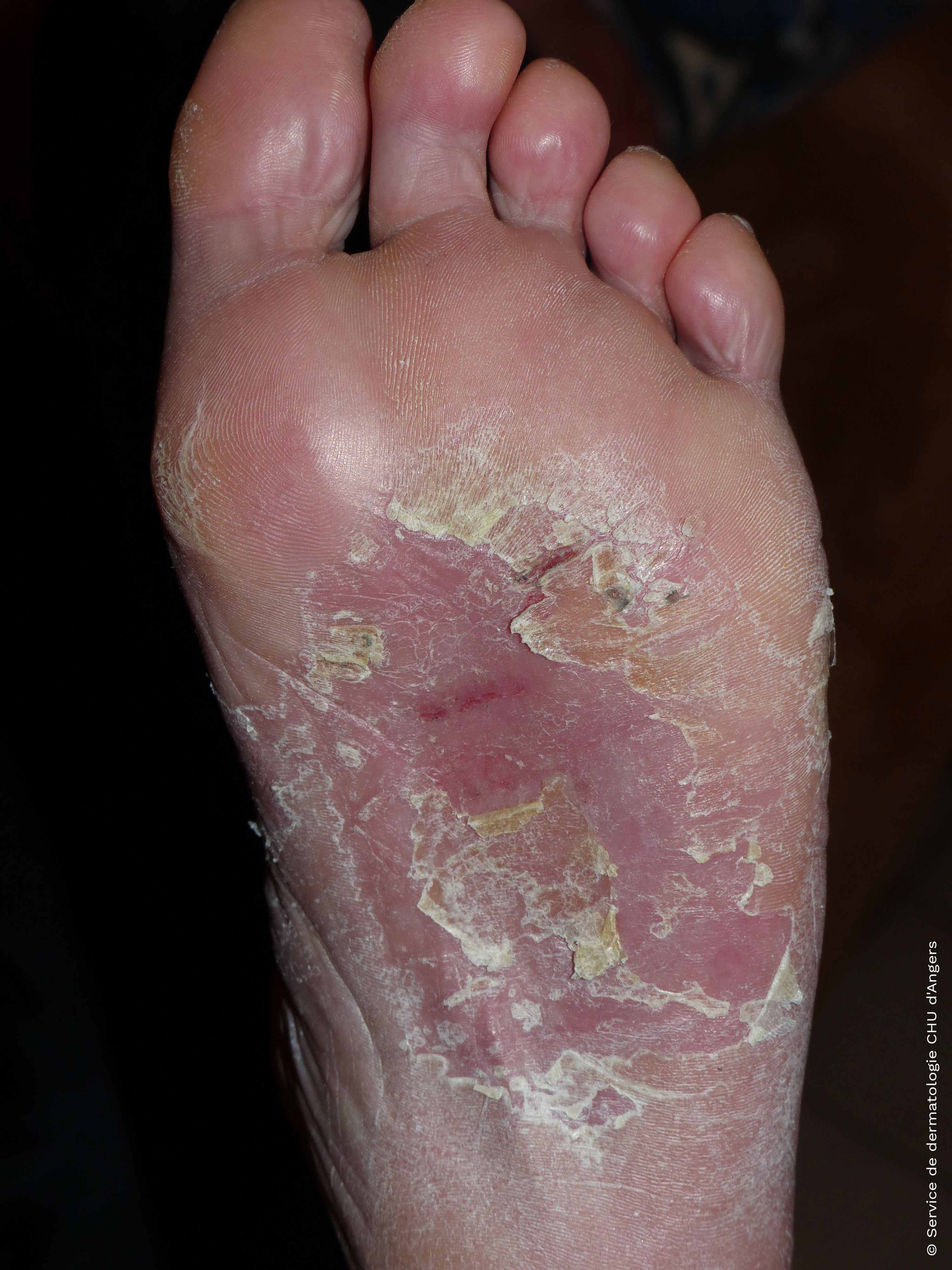 Eczema de contato dos pés à cola e ao couro dos sapatos