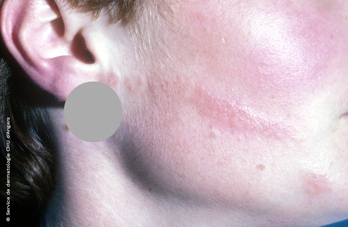 Eczema do rosto transportado pelas mãos a um antibiótico