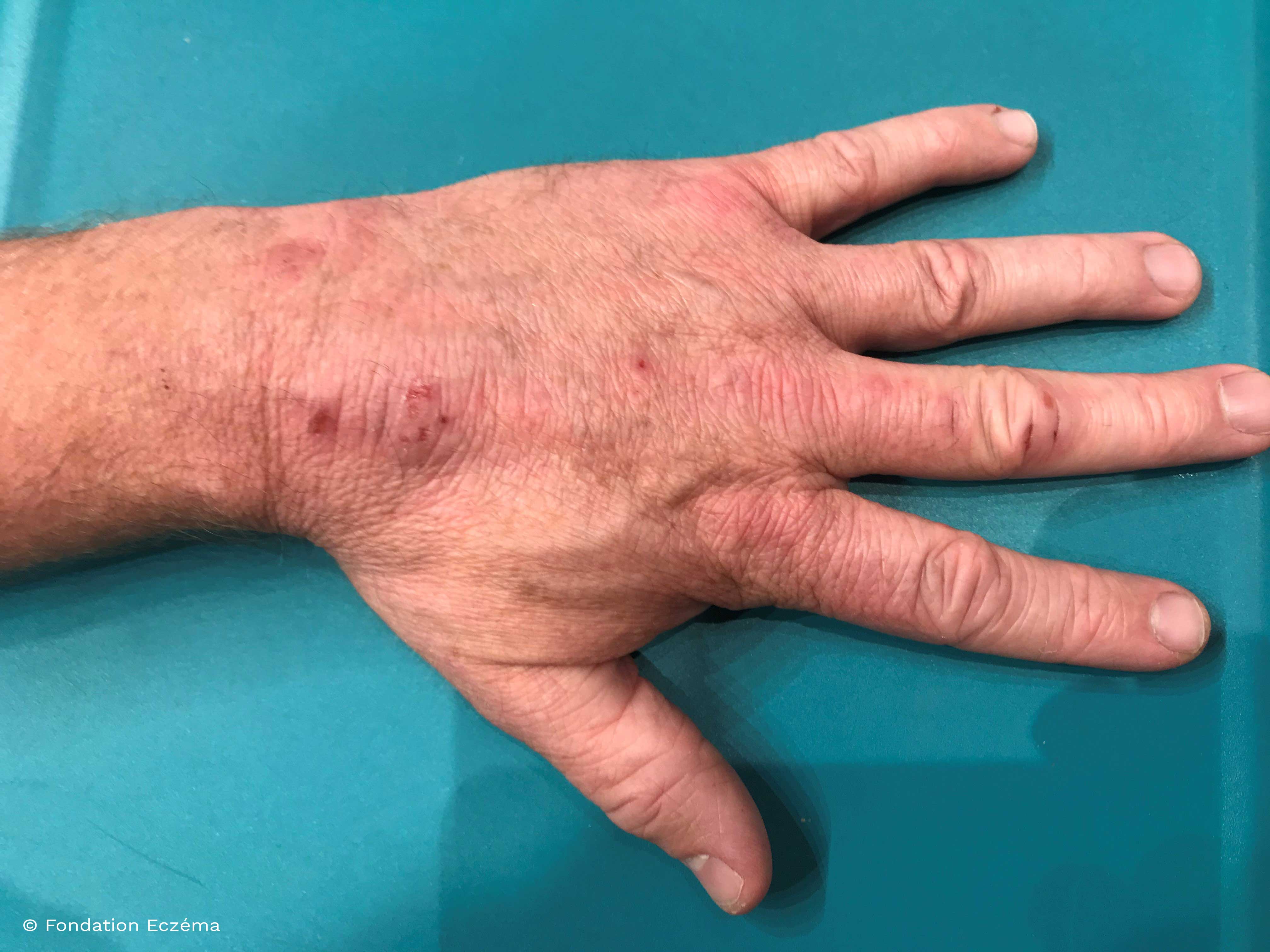 Dermatite atópica das mãos do adulto