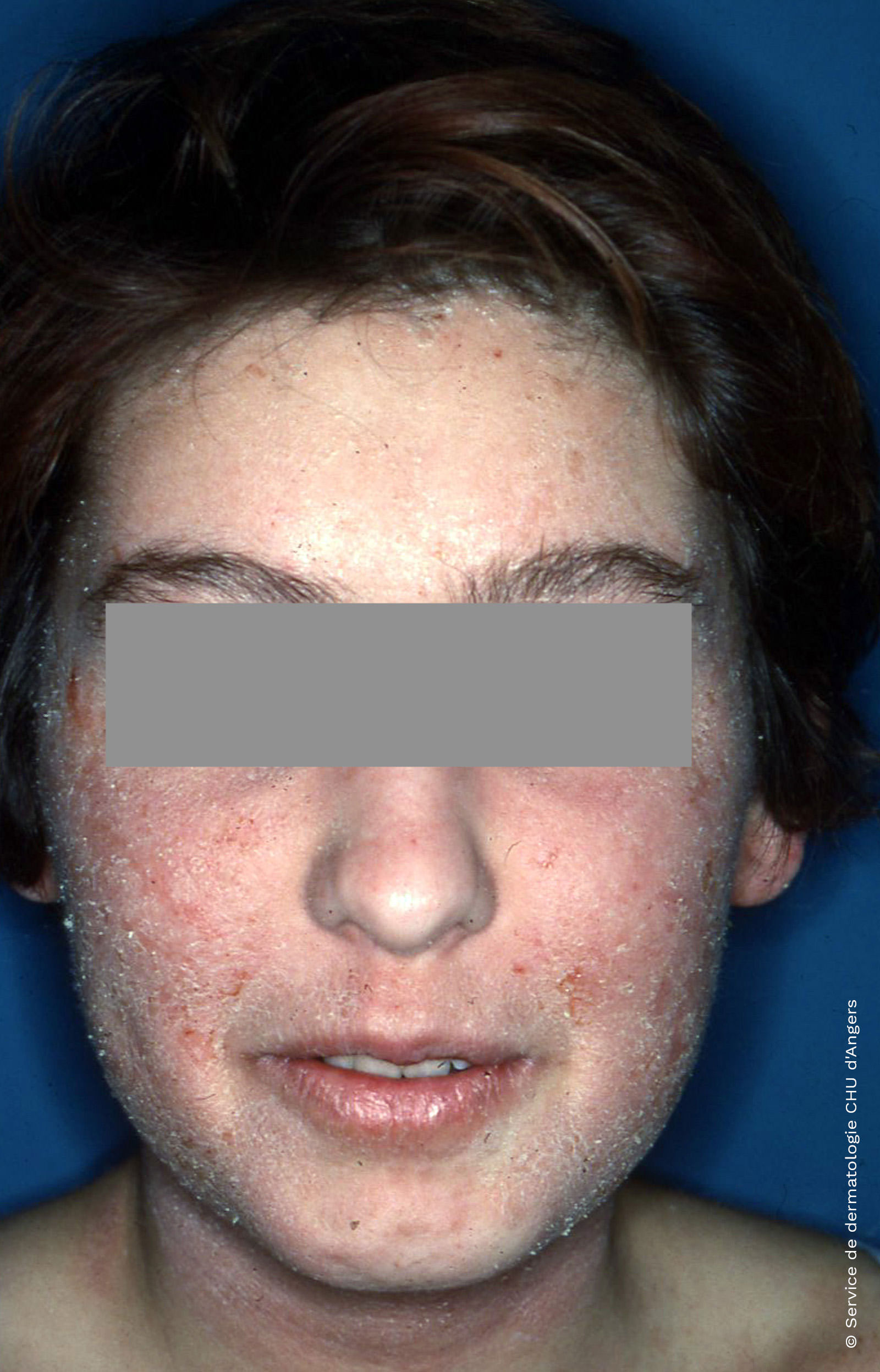 Eczema atópico do adulto no rosto