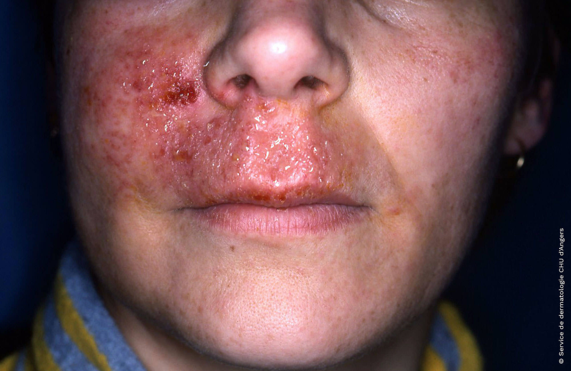Eczema de contato alérgico do rosto e dos lábios a um antisséptico