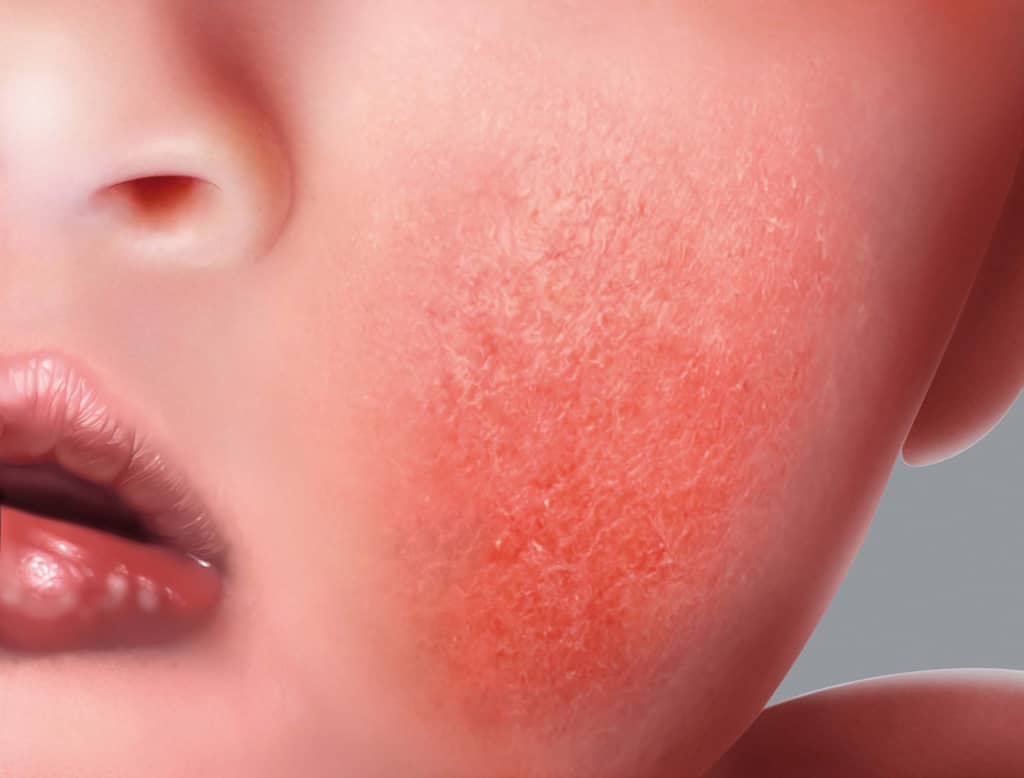 Síntomas del eczema atópico: eritema
