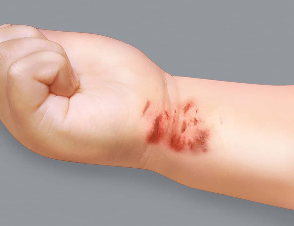 I sintomi dell'eczema atopico: escoriazioni