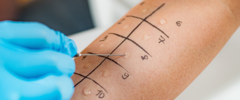 Identifying the cause of eczema through allergy tests