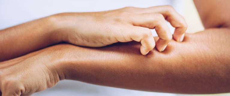 List of the different types of eczema