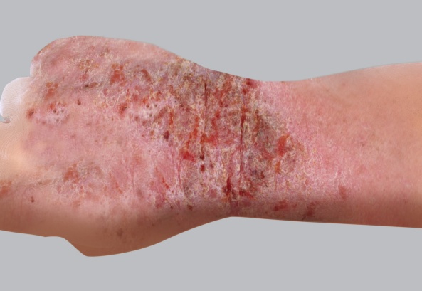 Symptômes de l'eczéma atopique : suintements (vésicules - croûtes)