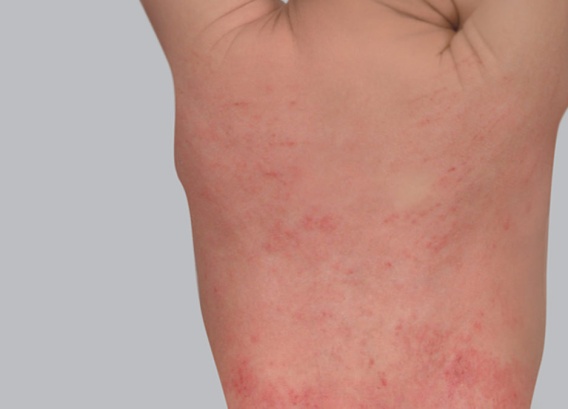 Atopic eczema symptoms: red patches or erythema