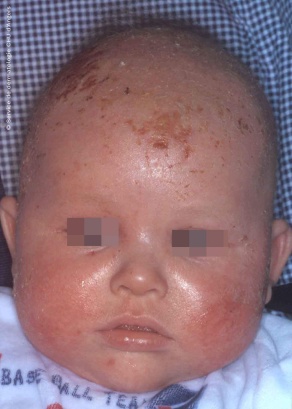 Atopic dermatitis in children