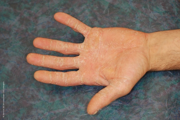 Dermatophytie de la paume de main diagnostic différentiel eczéma