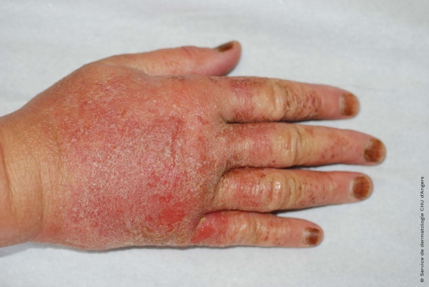 Acute eczema with tea tree oil