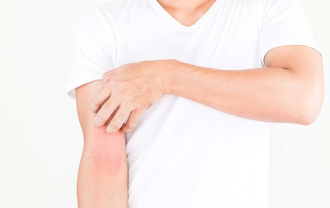 Atopic eczema on the arms