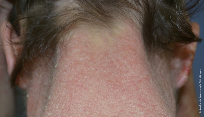 Atopic eczema of the neck