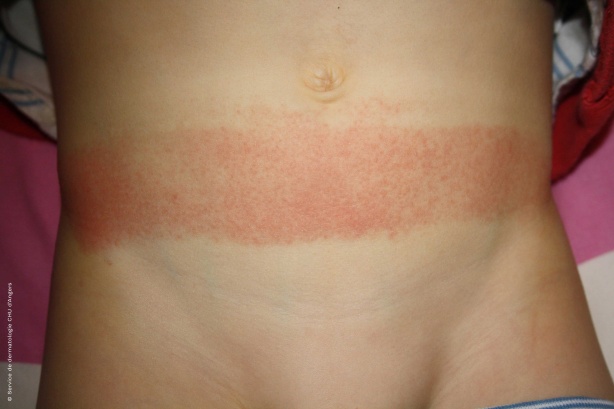 Rubber contact eczema abdomen child