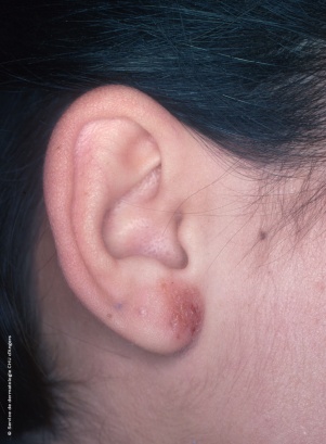 Eczema de contacto en la oreja debido al níquel