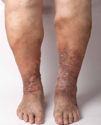 Varicose eczema