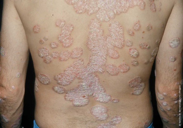 Psoriasis en plaques du dos