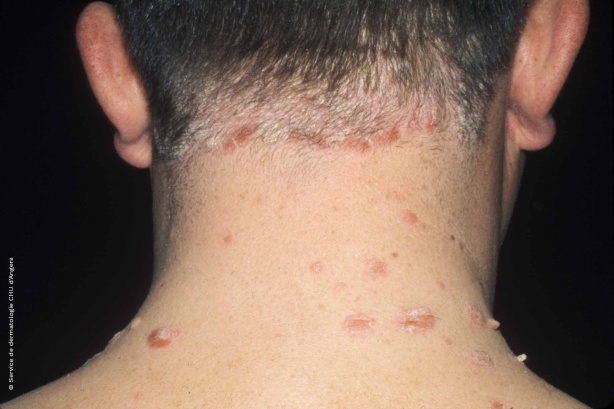 Psoriasis de la nuque