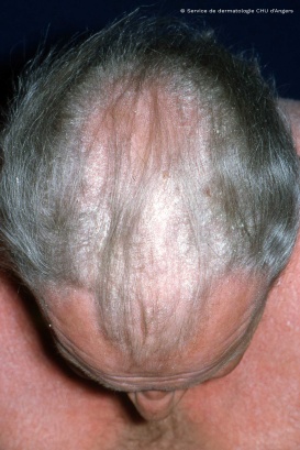 Psoriasis of the scalp