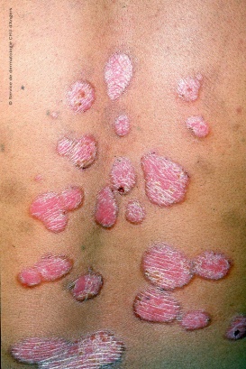 Plaque-Psoriasis