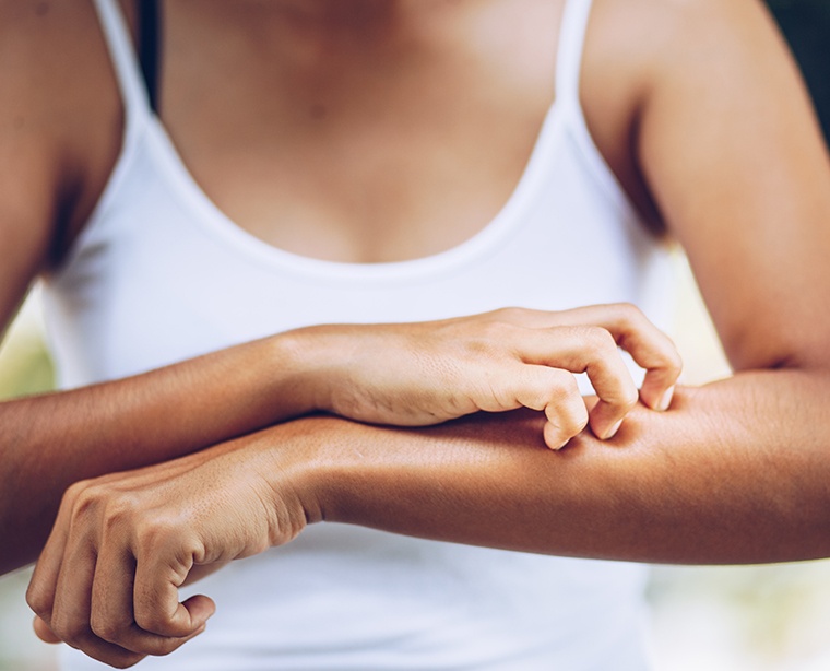 Les différents types d'eczémas