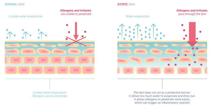 Atopic skin : skin barrier