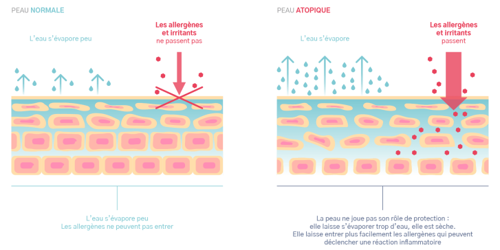 La cause fondamentale : une peau atopique