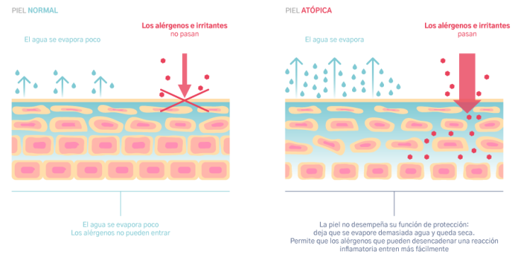 PIEL ATÓPICA