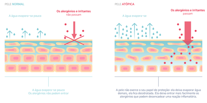  pele atópica