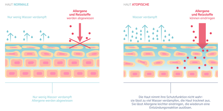 Die Grundursache: atopische Haut