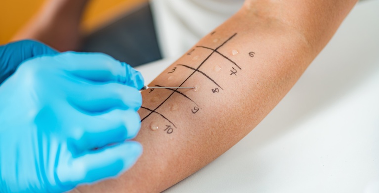 Identifying the cause of eczema through allergy tests